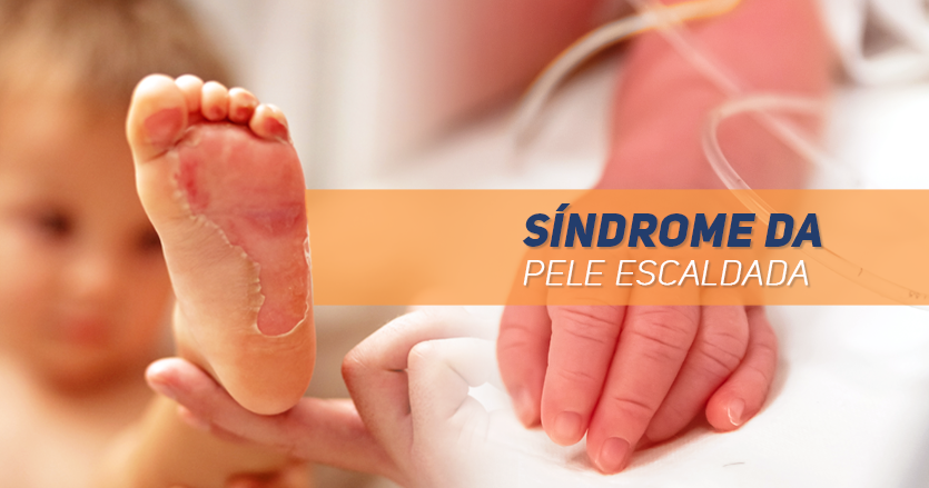 Síndrome da Pele Escaldada | PortalPed